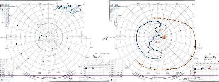 Ocular syphilis visual field