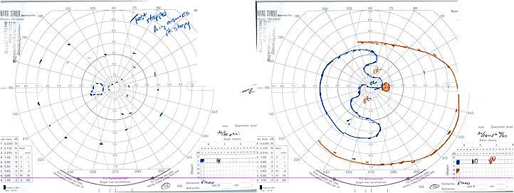 Ocular syphilis visual field