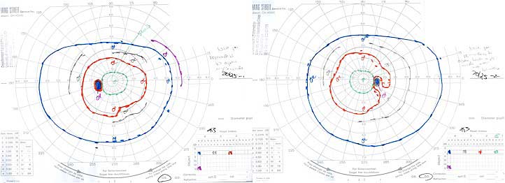 Ocular syphilis visual field