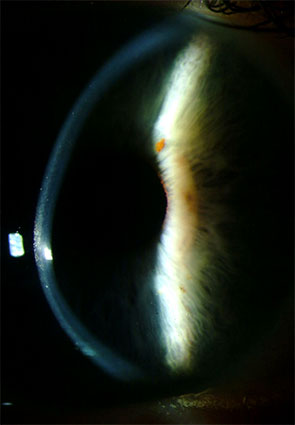 Right Eye Slit Lamp