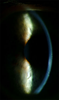 Left Eye Slit Lamp