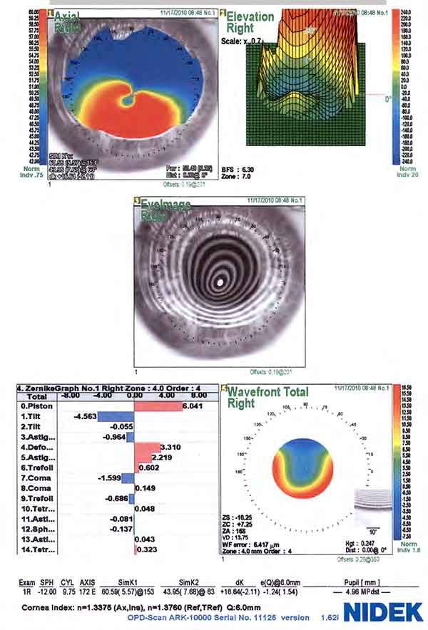 Corneal topography right eye