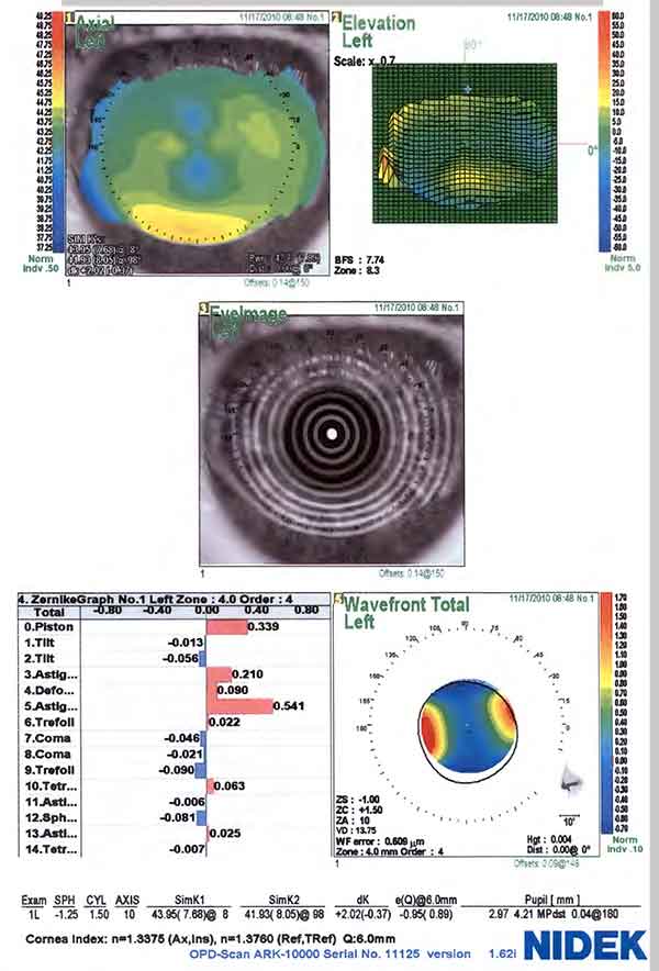 Corneal topography left eye