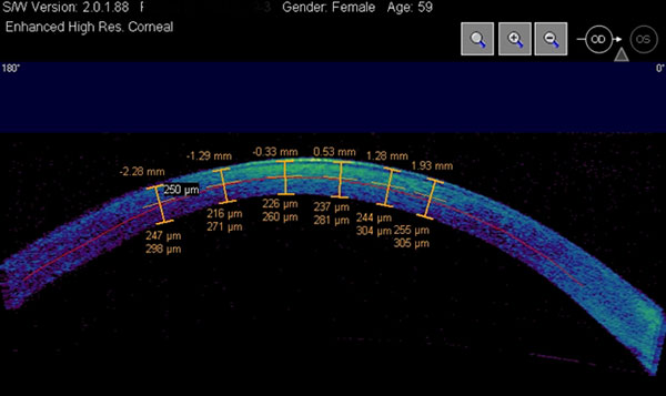 Optical coherence tomography