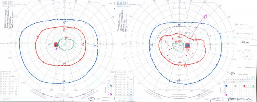 Goldmann perimetry