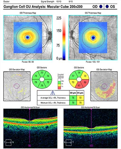 SD-OCT of ganglion cell + inner plexiform layer.