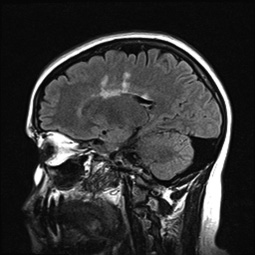 sagittal T2-flair sequence