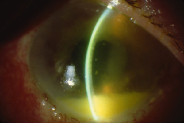 HSV keratouveitis with hypopyon