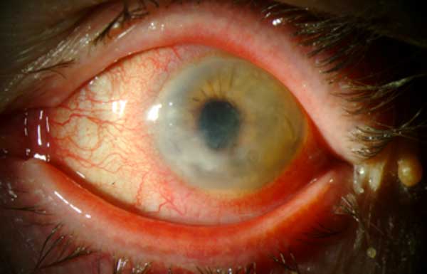 HSV keratouveitis with hypopyon