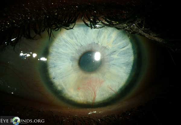 HSV stromal keratitis with resultant stromal vascularization