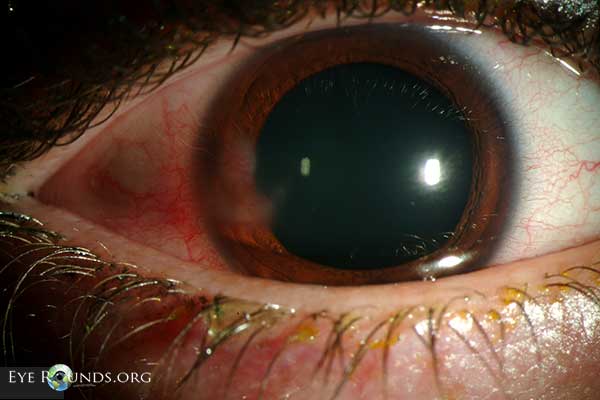 HSV stromal keratitis with resultant stromal vascularization