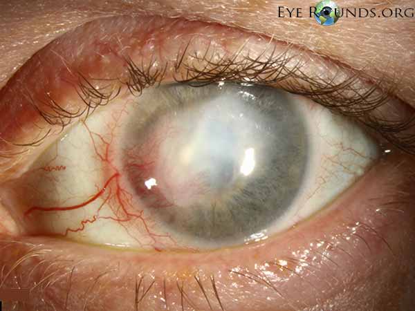 HSV stromal keratitis with resultant lipid keratopathy