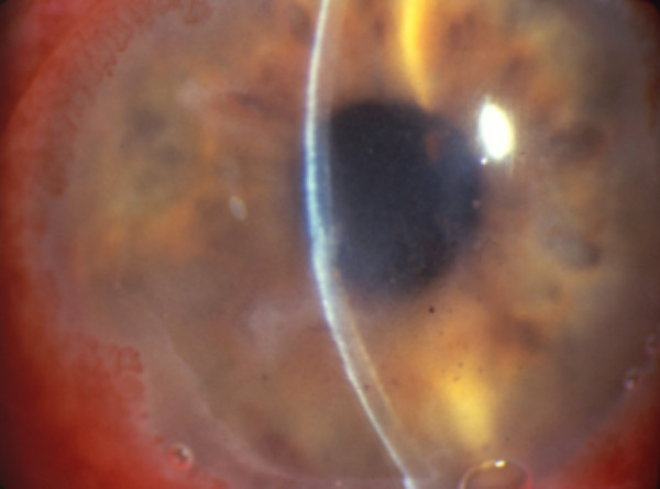 Disciform HSV keratitis