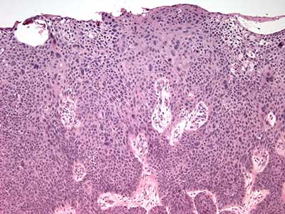 Scattered cells with large, pleomorphic nuclei and scattered mitotic figures are present.