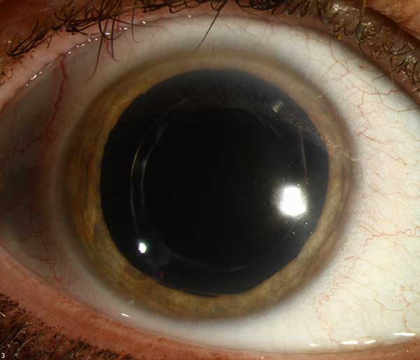 right eye