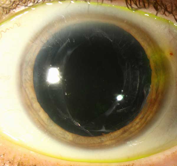 Left eye
