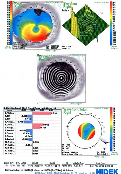 Corneal Toporaphy, right eye