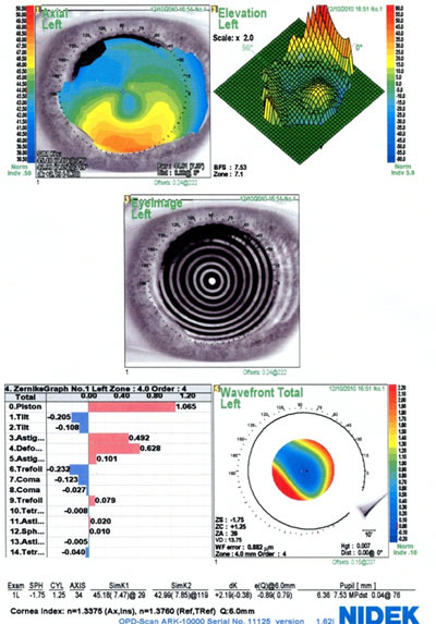 Corneal Toporaphy, left eye