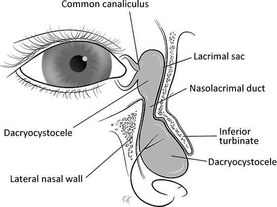 Dacryocystocele