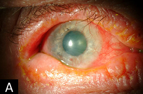 keratoconjunctivitis