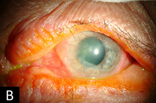 keratoconjunctivitis