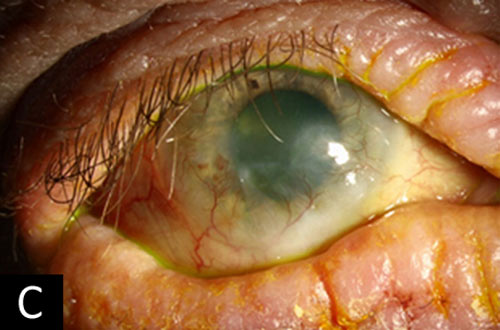 keratoconjunctivitis