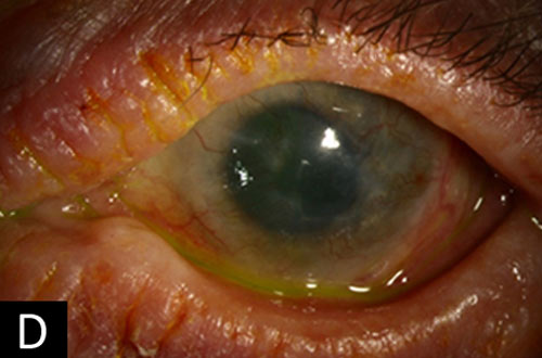 keratoconjunctivitis