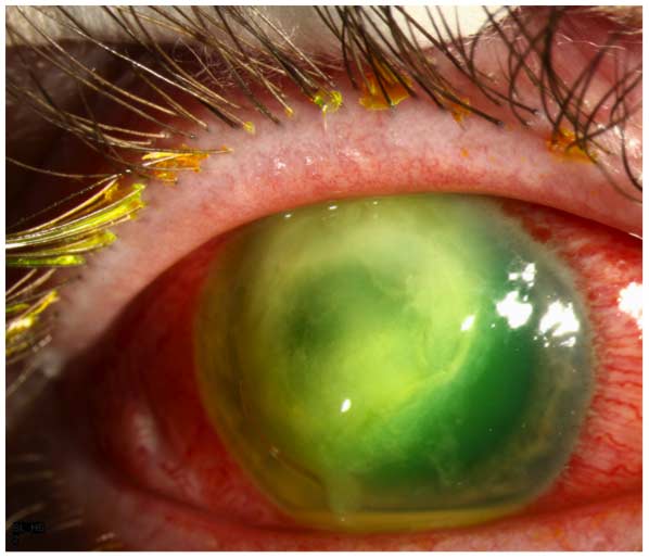 Pseudomonas keratitis