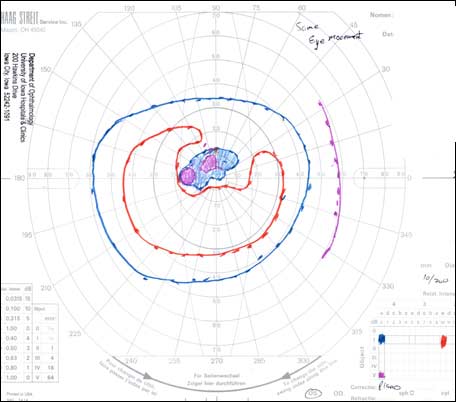 Goldmann visual field