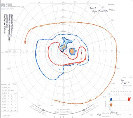 Goldmann Visual Field