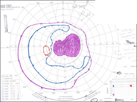 Visual Field