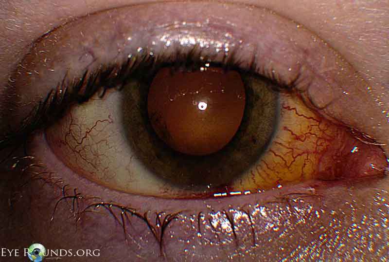 conjunctiva/sclera