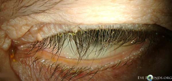 lagophthalmos, lash ptosis