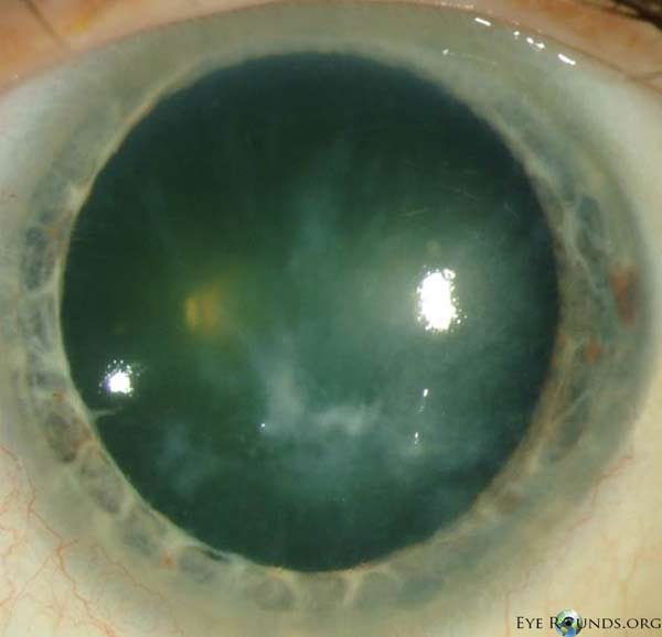 diffuse stromal haze with fine lattice lines/branching refractile opacities extending toward the limbus in a radial pattern and some nodularity just inferior to the visual axis