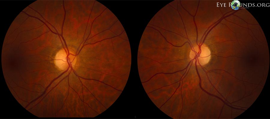 Color Fundus