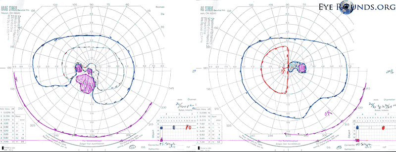 Goldmann visual field