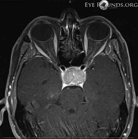 Post-contrast t1 brain MRI, axial