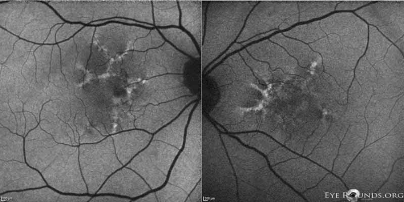 Fundus autofluorescence