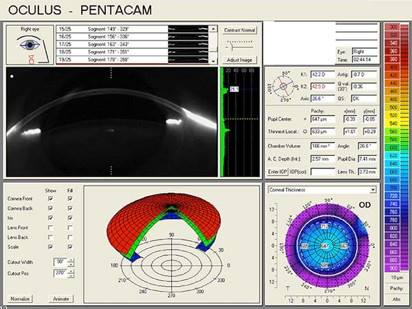 right eye, Pentacam anterior segment tomography