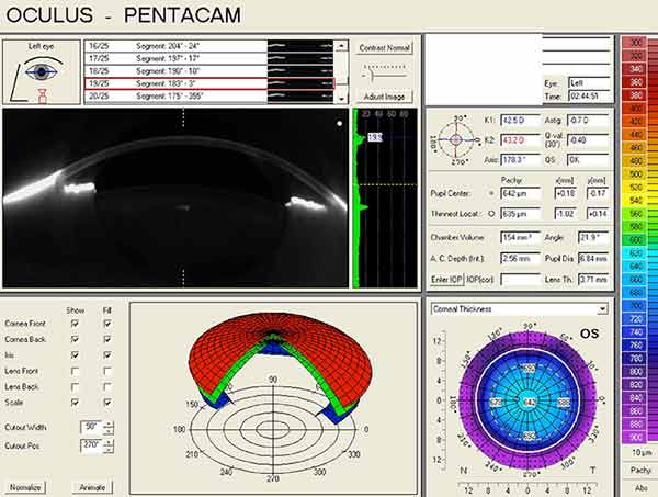 right eye, Pentacam anterior segment tomography, LEFT EYE