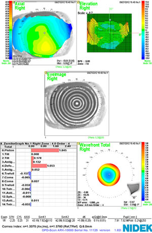 Topography, right eye