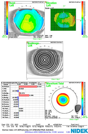 topography, left eye