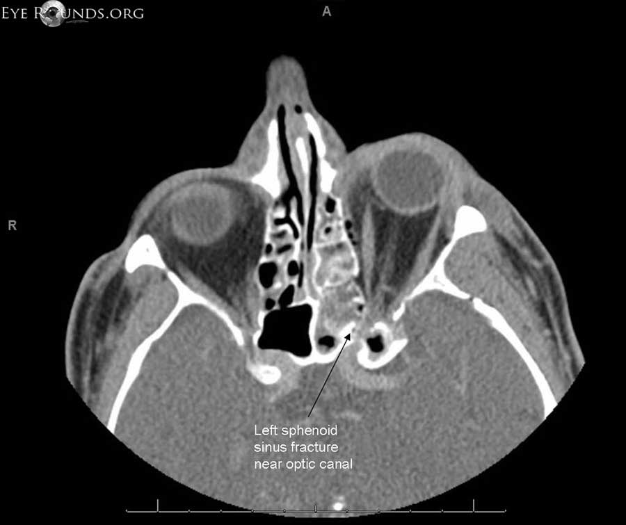 Axial computed tomography (CT) scan showing fracture of posterolateral aspect of left sphenoid sinus in area of left optic canal