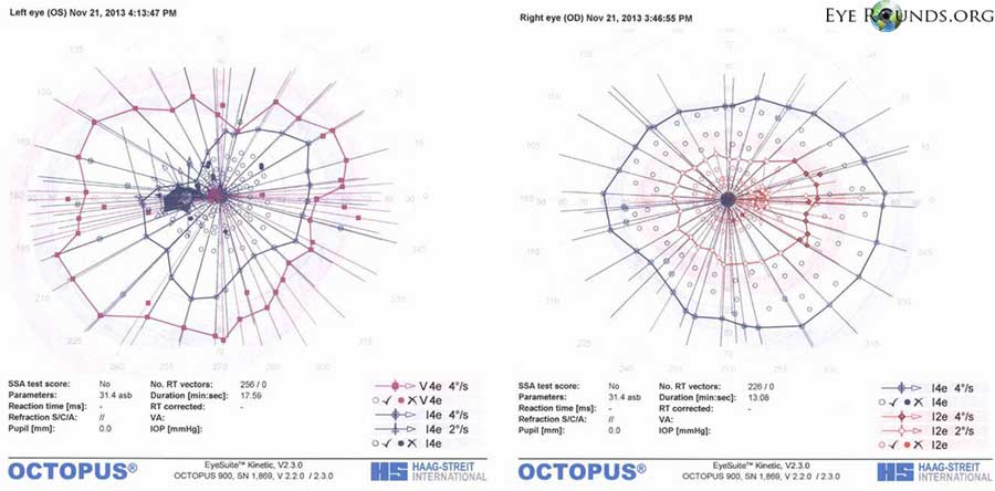 Octopus kinetic perimetry 3 weeks after the injury showing a normal visual field OD and loss of the I2e isopter, with depression of remaining isopters, OS