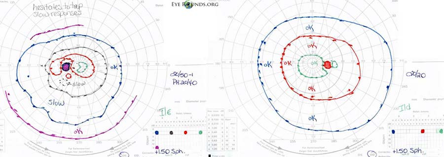 Goldmann kinetic perimetry 6 weeks after the injury showing a normal visual field OD with depression of all isopters OS. Note presence of I1e isopter OS