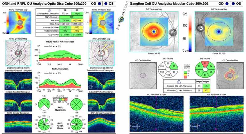 Cirrus OCT imaging indicating thinning of the retinal nerve fiber layer and the ganglion cell layer OS