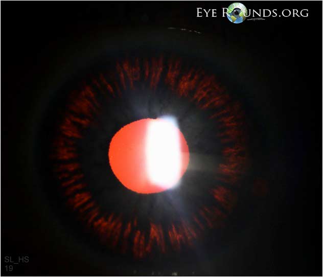 Slit lamp photograph showing marked midperipheral radial iris transillumination defects