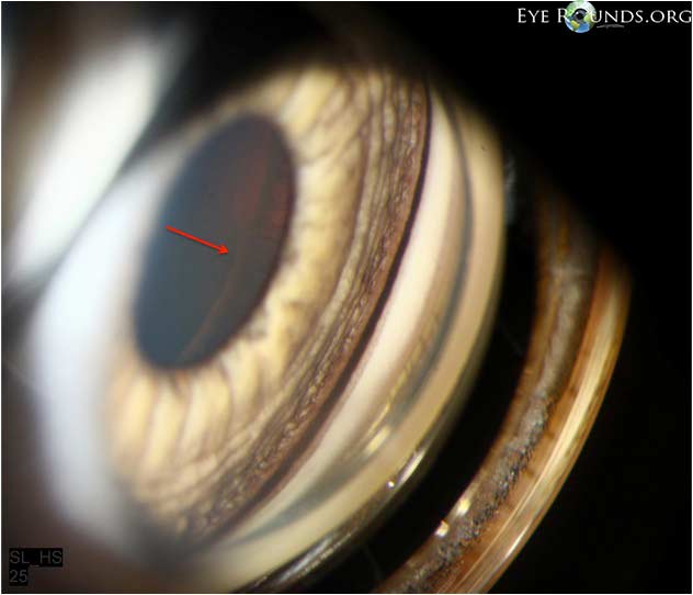 Gonioscopic photo demonstrating a Scheie stripe