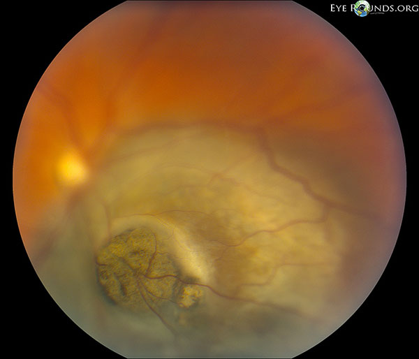 Close-up of lesion showing disruption of Bruch's membrane and nodular tumor eruption in a pathognomonic "collar button" shape.