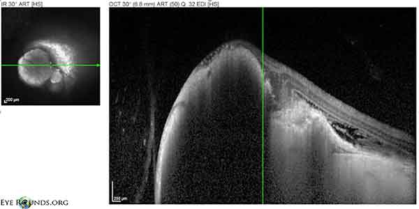 OCT showed a choroidal mass with disruption the RPE and Bruch's membrane and associated subretinal fluid. 